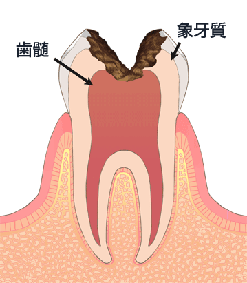 中程度のむし歯（C2,C3）