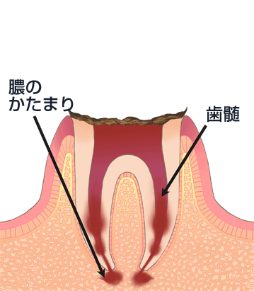重度のむし歯（C4）